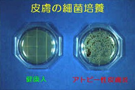 「アトピー 黄色ブドウ球菌」の画像検索結果